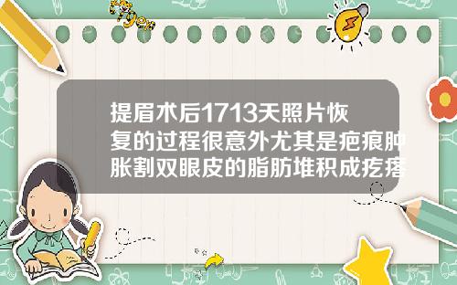 提眉术后1713天照片恢复的过程很意外尤其是疤痕肿胀割双眼皮的脂肪堆积成疙瘩图片