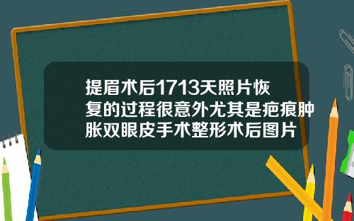 提眉术后1713天照片恢复的过程很意外尤其是疤痕肿胀双眼皮手术整形术后图片