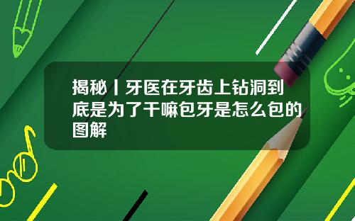 揭秘丨牙医在牙齿上钻洞到底是为了干嘛包牙是怎么包的图解