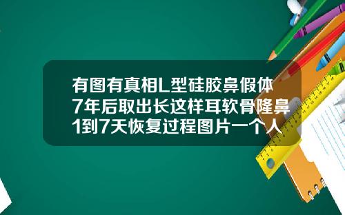 有图有真相L型硅胶鼻假体7年后取出长这样耳软骨隆鼻1到7天恢复过程图片一个人