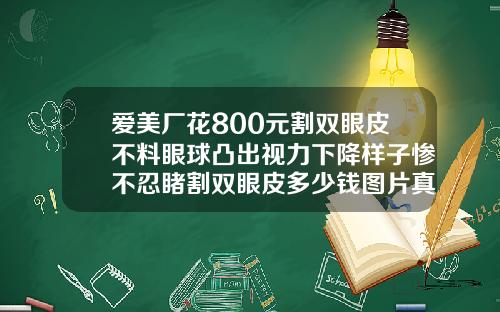爱美厂花800元割双眼皮不料眼球凸出视力下降样子惨不忍睹割双眼皮多少钱图片真实