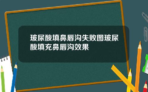 玻尿酸填鼻唇沟失败图玻尿酸填充鼻唇沟效果