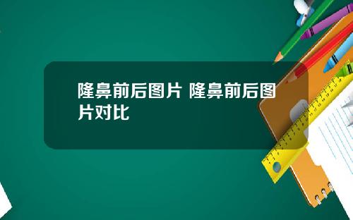 隆鼻前后图片 隆鼻前后图片对比