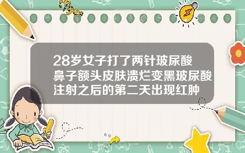 28岁女子打了两针玻尿酸鼻子额头皮肤溃烂变黑玻尿酸注射之后的第二天出现红肿