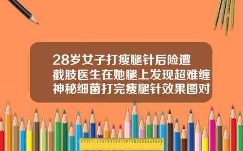 28岁女子打瘦腿针后险遭截肢医生在她腿上发现超难缠神秘细菌打完瘦腿针效果图对比