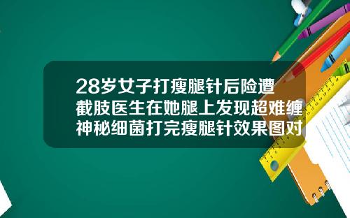 28岁女子打瘦腿针后险遭截肢医生在她腿上发现超难缠神秘细菌打完瘦腿针效果图对比