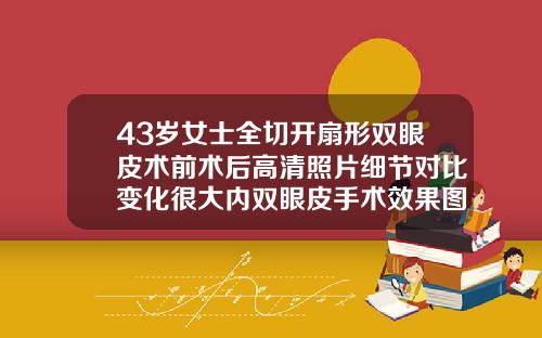 43岁女士全切开扇形双眼皮术前术后高清照片细节对比变化很大内双眼皮手术效果图