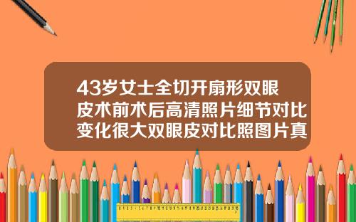 43岁女士全切开扇形双眼皮术前术后高清照片细节对比变化很大双眼皮对比照图片真人