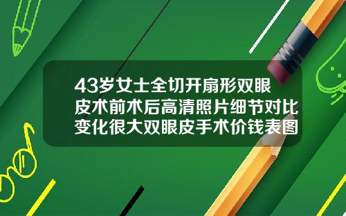 43岁女士全切开扇形双眼皮术前术后高清照片细节对比变化很大双眼皮手术价钱表图片