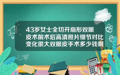 43岁女士全切开扇形双眼皮术前术后高清照片细节对比变化很大双眼皮手术多少钱啊图片