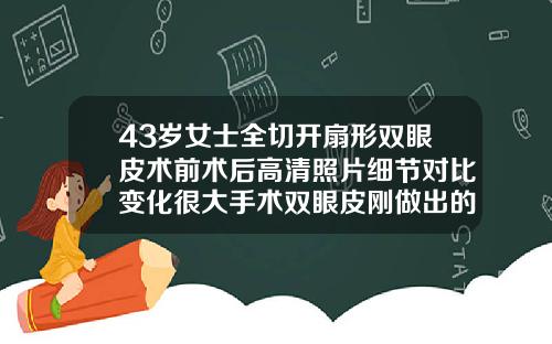 43岁女士全切开扇形双眼皮术前术后高清照片细节对比变化很大手术双眼皮刚做出的图