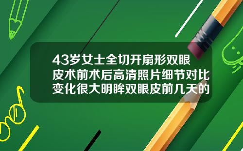 43岁女士全切开扇形双眼皮术前术后高清照片细节对比变化很大明眸双眼皮前几天的照片
