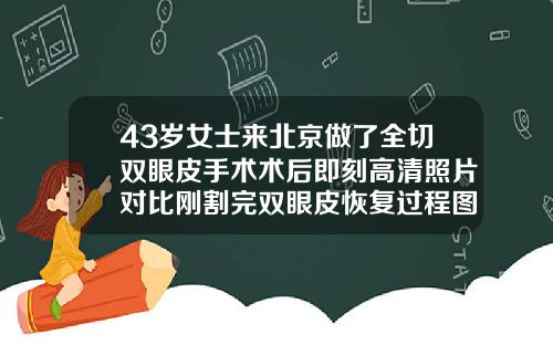43岁女士来北京做了全切双眼皮手术术后即刻高清照片对比刚割完双眼皮恢复过程图片