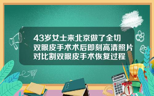 43岁女士来北京做了全切双眼皮手术术后即刻高清照片对比割双眼皮手术恢复过程
