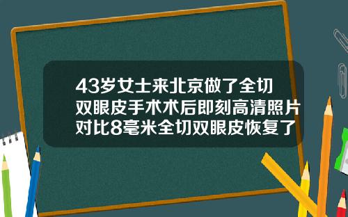 43岁女士来北京做了全切双眼皮手术术后即刻高清照片对比8毫米全切双眼皮恢复了直观多宽