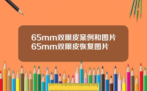 65mm双眼皮案例和图片65mm双眼皮恢复图片