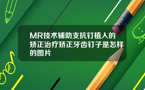 MR技术辅助支抗钉植入的矫正治疗矫正牙齿钉子是怎样的图片
