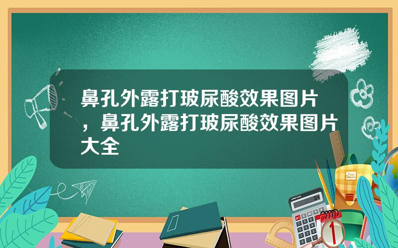 鼻孔外露打玻尿酸效果图片，鼻孔外露打玻尿酸效果图片大全